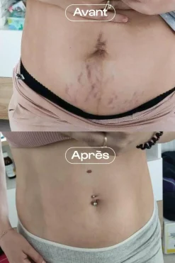 Concentré correcteur vergetures L’Expert